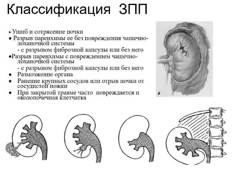 Классификация  ЗПП  Ушиб и сотрясение почки  Разрыв паренхимы ее без повреждения